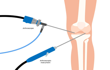 Arthroscopy and Cartilage Repair