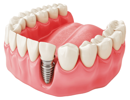 Dental Implants and Full Mouth Rehabilitation Icon