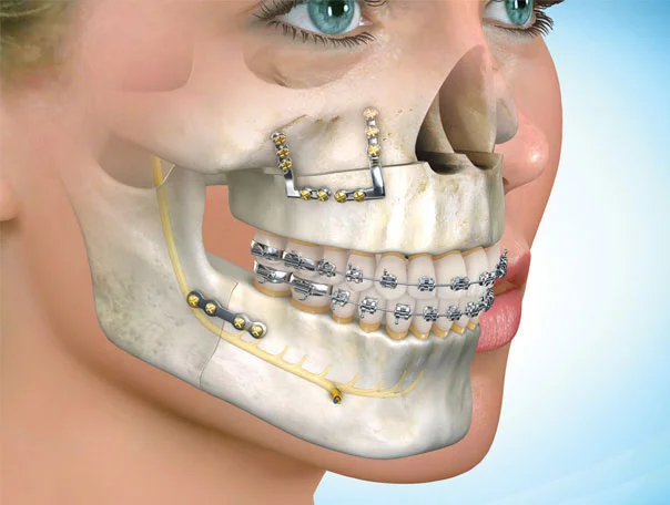 Orthognathic (Jaw Alignment) Surgery Icon